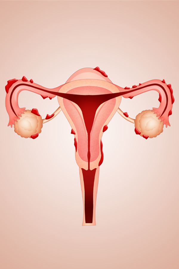 toronto-cara-flamer-endometriosis Toronto Cara Flamer Endometriosis